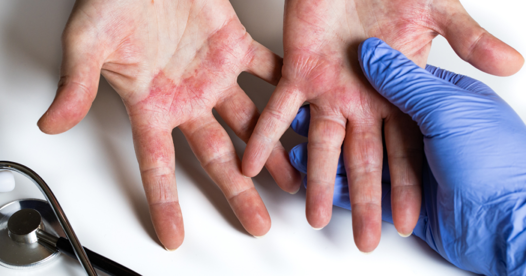 hands with contact dermatitis rash